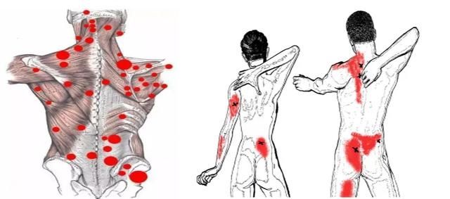 扳机点|你不能忽视的肌肉扳机点，85%的疼痛和它有关