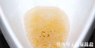 尿毒症|接连感冒被查出尿毒症,肾病早期会有4个“求救”信号,不妨一看