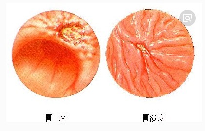 胃癌|警惕胃癌的5个“信号”，看你是不是高危人群