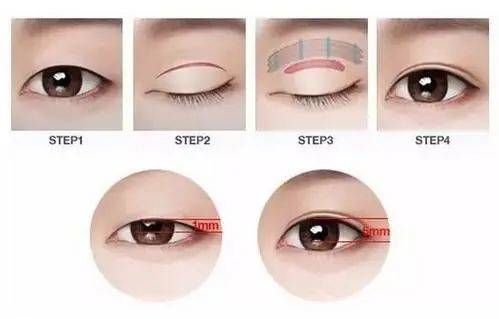 整形|济南海峡整形分享：暑假为什么越来越的人选择做双眼皮？