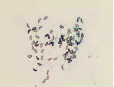 穿刺胆道|吓人男子胆汁里竟发现虫子只因吃了这个……