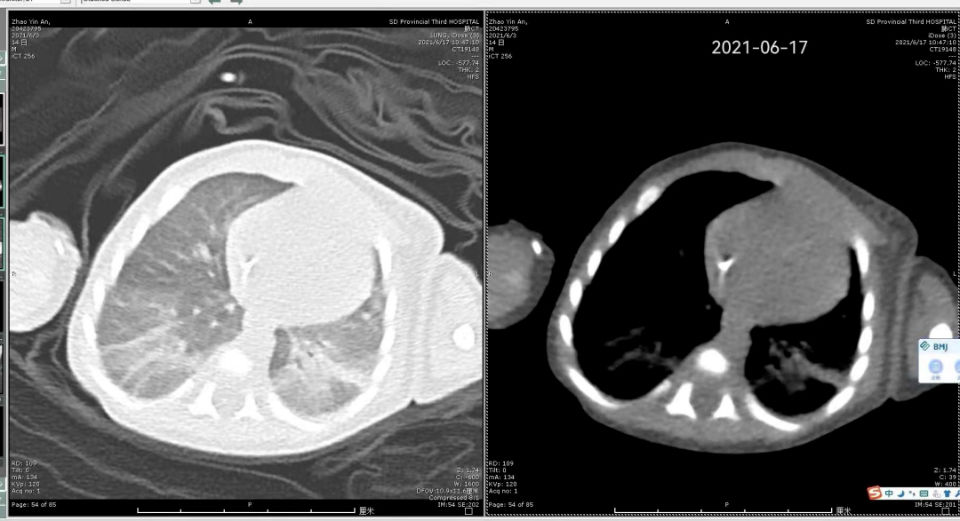 危重症|32天早产危重症患儿实施纤维支气管镜检查治疗