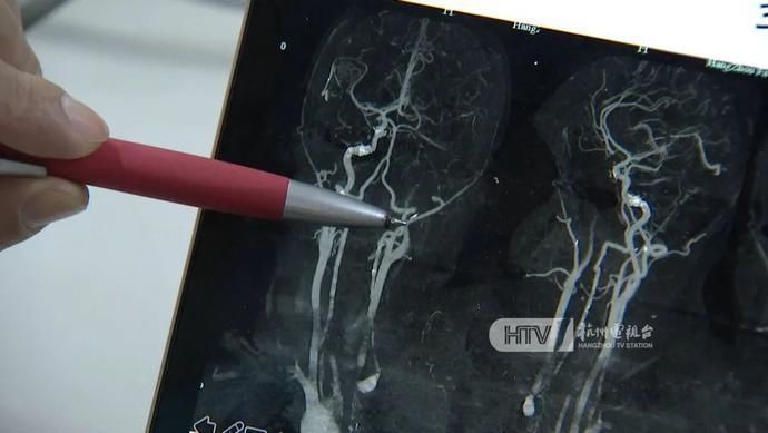 中风|突然倒地!15岁男生成这家医院“年龄最小的”中风患者……他几乎没喝过白开水!