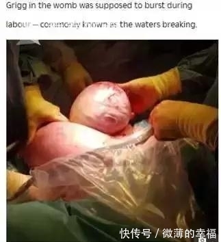 女子|女子剖腹产子，医生从肚子里取出一个肉球！网友：这是哪吒啊