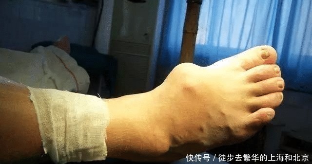 百合|最强天然“痛风”药,不是百合,不是车前草,喝一碗就能降尿酸!