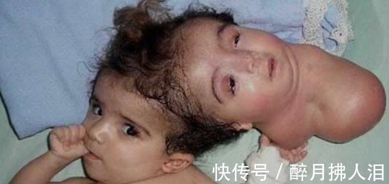 诺拉|小女孩从小有“双头”,进行割头手术