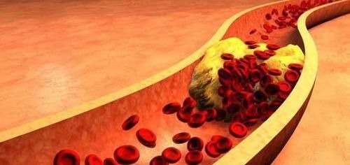 血脂升高|血脂高不高,看脚就知道,若没有这4种症状,恭喜,血管还算通畅