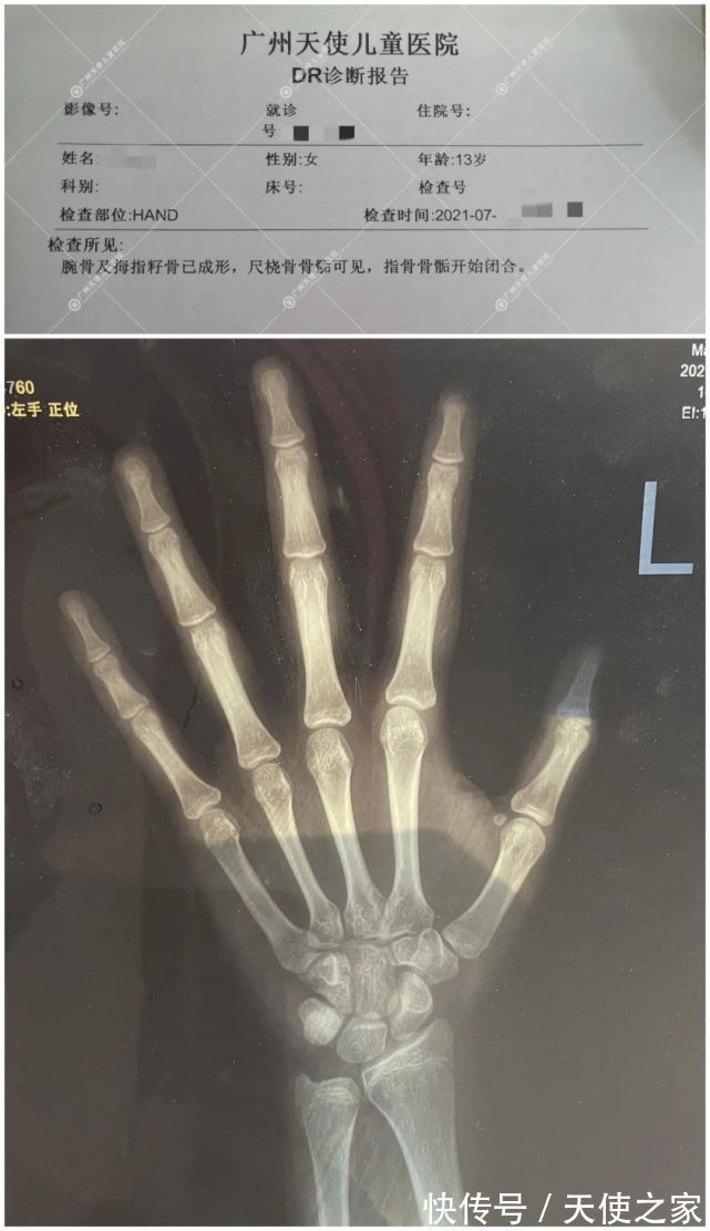 诊断|13岁女孩被诊断矮小症,5个月干预终于长高了5㎝!