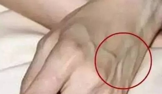 标志|肝脏好的人，手上都有这“5个标志”，看看你的手上有没有