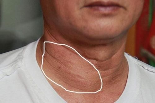 包块|癌症早期有什么症状?如何才能早发现?