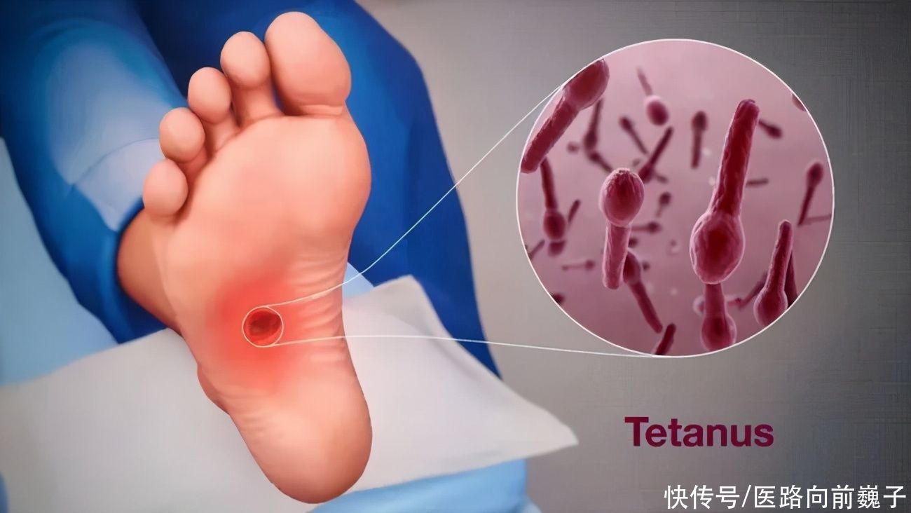 潜伏期|每年100万人死于此病！医生：身上的伤口别这样处理