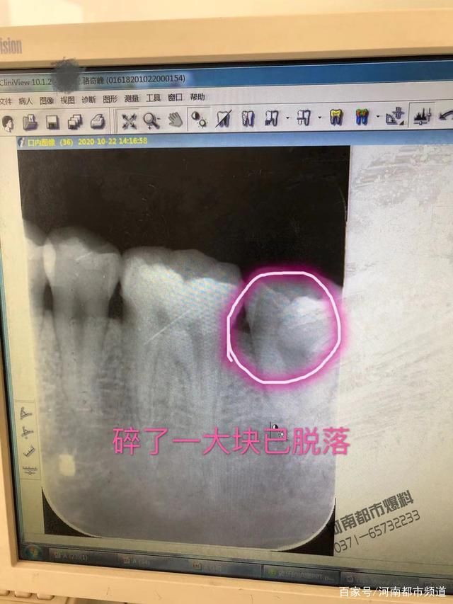 紫薯糯米球中“藏”钢珠，崩坏我的牙！厂家：12万元赔偿不可能！