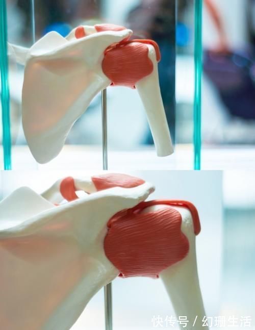 肌腱|肩膀疼痛都是“肩周炎”吗？医生：你错了，肩周炎只占很少一部分