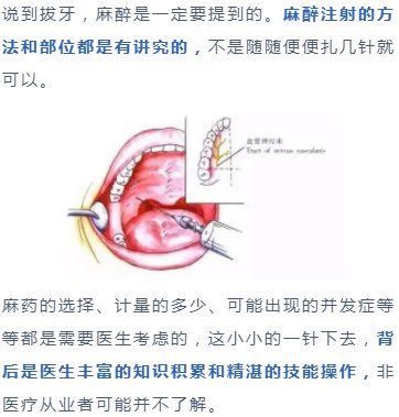 拔除|别人拔智齿只要几百块，我拔智齿却很贵，是我被坑了吗？