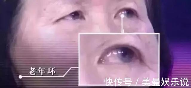 血管|脸上出现这2个变化,要注意了!降血脂、护血管的食物都在这了