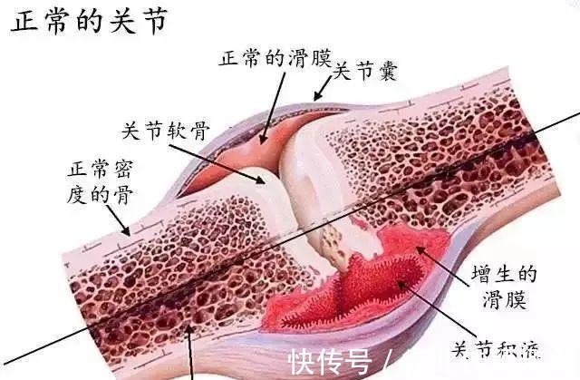 膝盖|膝盖肿有积液？一妙方消肿止痛，活血化瘀，专家说一月赶走滑膜炎