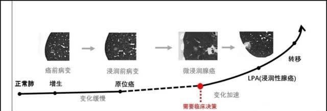 1年看上万张片子的医生透露：如何判断肺结节是不是肺癌？