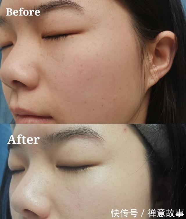 仪器 医美界的万金油,光子嫩肤探店!