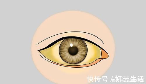 眼睛|肝癌不会突然发生！医生：身体会给3次机会，若不抓住，后悔莫及