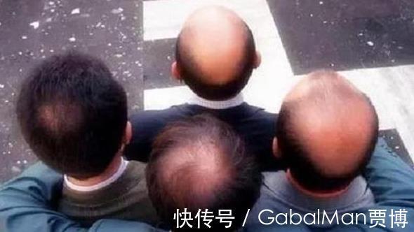 地中海|地中海发型和戴假发,你更不能接受哪个?