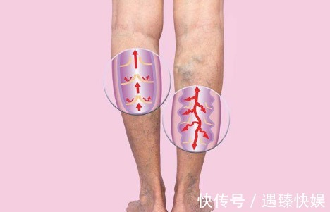 相伴|晚上睡觉时,若出现4个现象,很抱歉,你的身体已被“血栓”占领