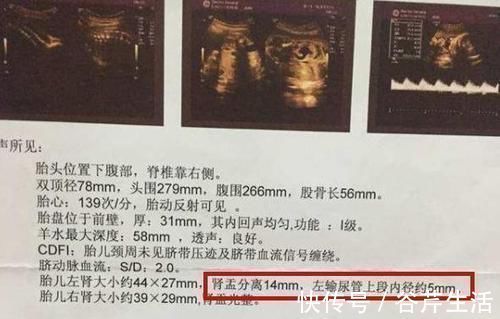 肾盂分离|通过产检B超单的“肾盂分离”,可判断胎儿性别还真有一定道理