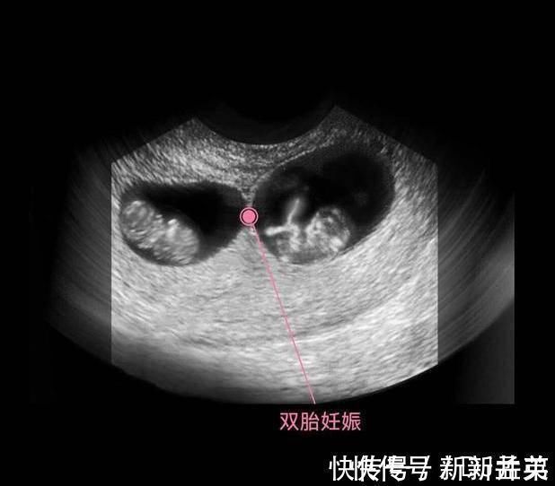 羊水|胎儿从卵泡到性别形成,17张图片清晰诠释,男宝女宝看得很清楚