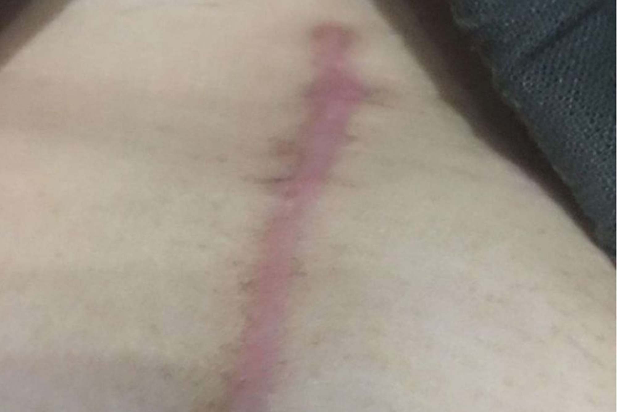 宝妈|“我没说要竖刀啊”,为什么剖腹产医院默认竖刀女性要提前了解