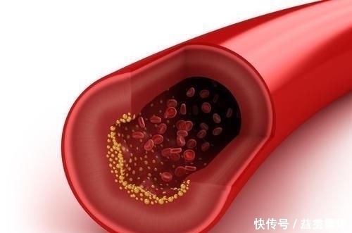 中医院士1个食疗方，开水里放1物，血管干净、高血脂降了