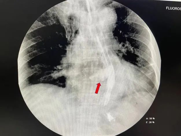 icu|吃了两口粽子，大爷胸背部突然剧烈疼痛，这种急症太凶险