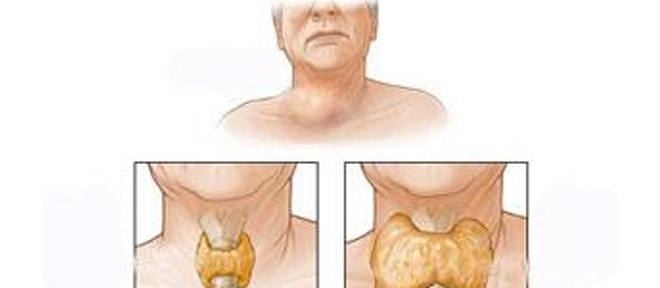 甲状腺结节出现以下一个危险因素即可诊断为甲状腺癌