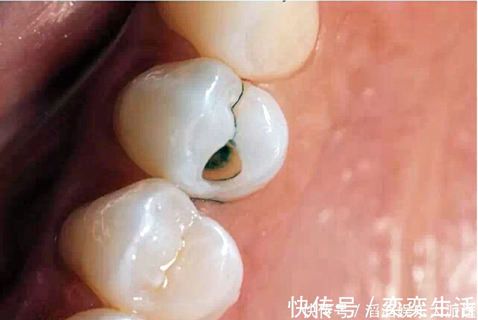 孩子|好不容易等到宝宝换牙期,新牙却长歪了医生家长无知惹得锅