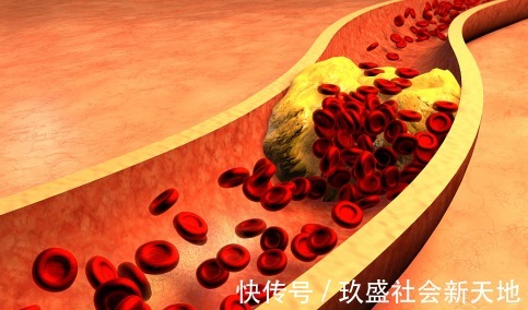 高血脂患者|血液的“加速器”已被揪出,常吃这“3物”,当心高血脂“上门”