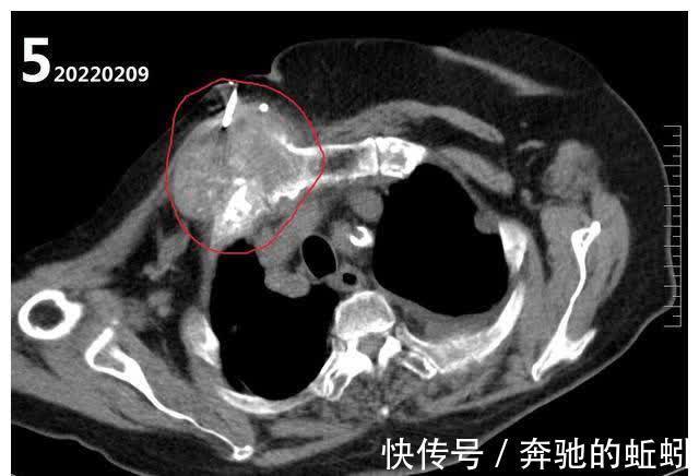 ct|如果不治疗的话,肺癌的发展速度到底有多快?