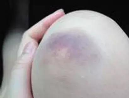 不起眼的紫斑,可能是大病的预兆!