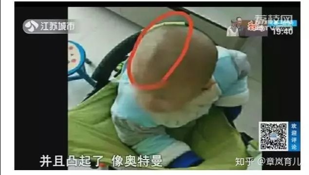 头型|花费近两万给婴儿戴石膏头模矫正头型？更需要“矫正”的是育儿观