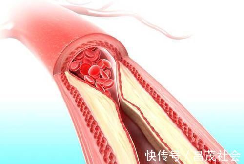 院士|血脂高的人能够吃鸡蛋吗?院士提醒:要想血脂不升高,少吃2物