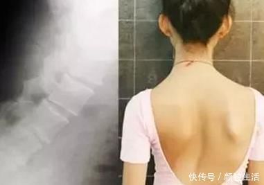 颈椎|12岁女孩弯腰时一个动作,被父母发现异常10个孩子就有2个中招