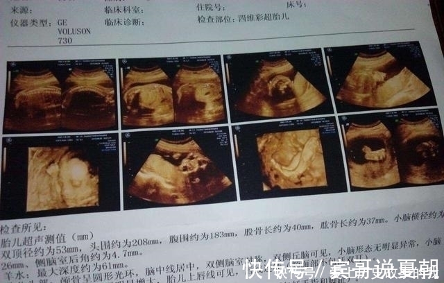 四维|四维彩超,孕妈们最期待的产检,除了看宝宝的照片还需要看什么?