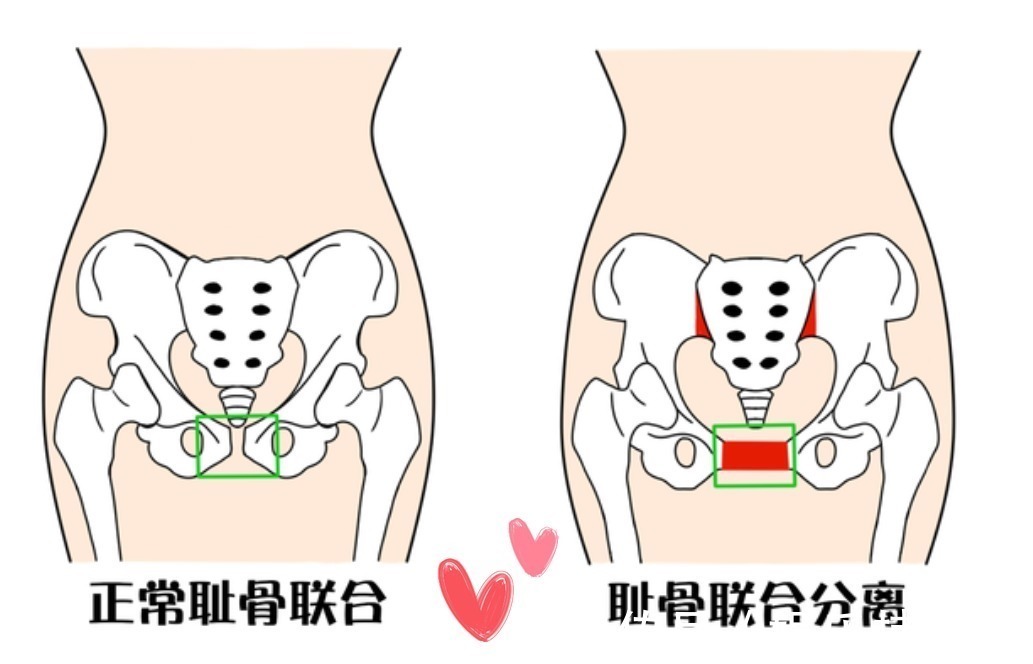 孕妈|准妈妈耻骨疼得越早,娃生的就越快生宝宝快的孕妈有这三大特征