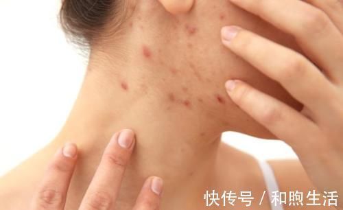 症状|医生提示:身体出现6个症状,十有八九是肝硬化,占一个也要CT