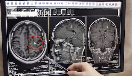 活虫|为了滋补生吞蛇胆！男子说话结巴 颅内取出活虫