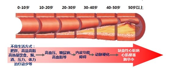 防治|科学防治心肌梗死