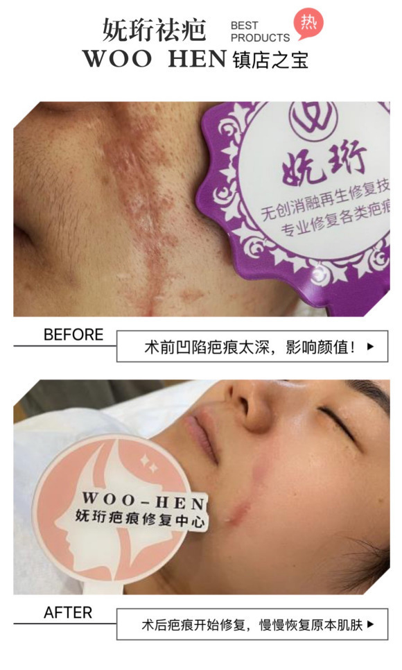 治疗 妩珩肤魅疤痕修复手术一般多少钱