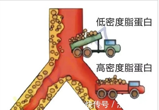 血脂|高血脂不疼不痒无需在意辟谣高血压长期不控制会导致这些疾病