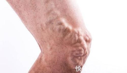 血管堵塞|老人脚上出现3种感觉，需警惕，这或暗示你血管已堵塞，莫忽视