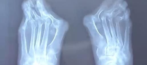 王女士 爱穿高跟鞋的女性一定要小心,拇指外翻堪比“裹脚”!不可忽视