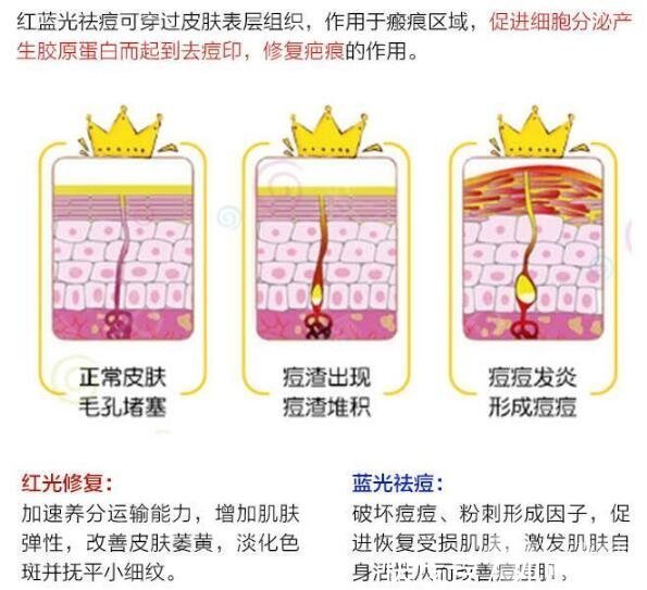 痤疮 怎么去痘|日常战痘还不够,4种医美光电项目来帮你get干净皮肤!