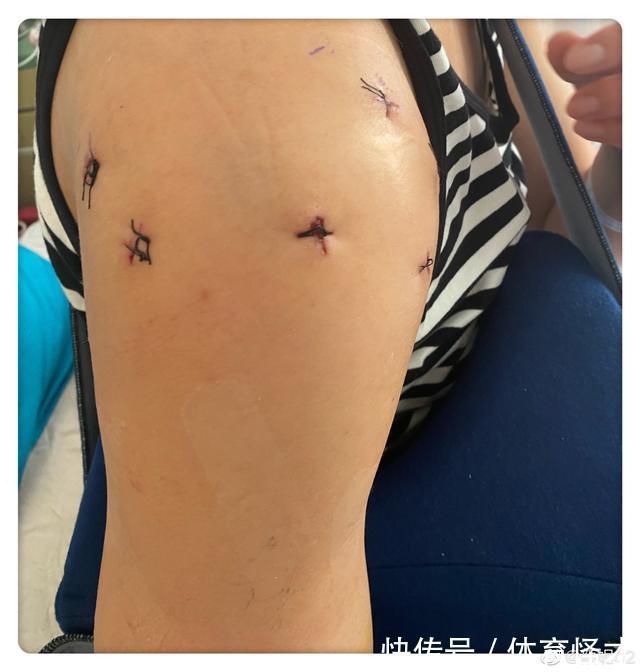 冈上肌|心疼!女排奥运冠军肩膀植入8颗钉,还得做右膝手术,颜妮报平安