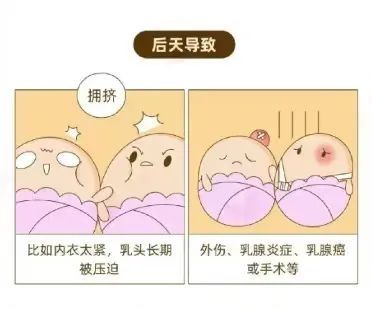 乳腺癌|乳头凹进去了怎么办？会是乳腺癌吗？干货！